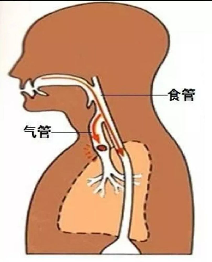 1 气管异物呛噎 宝宝将本应该进入食道的食物或其他异物,误吸到了