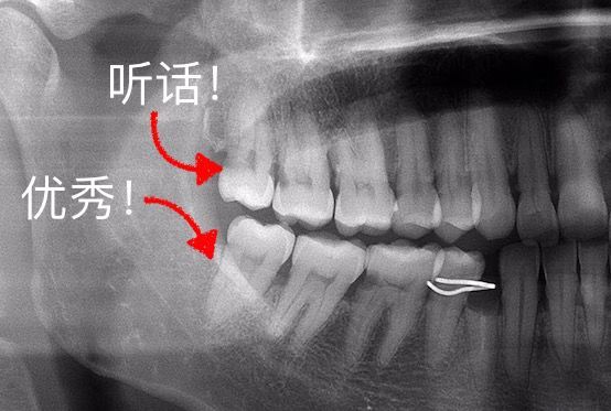 智齿不痛就不用拔吗?看了这篇你就懂了!