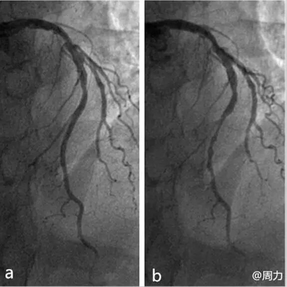 a. 冠脉造影显示在舒张期的前降支中段;b.