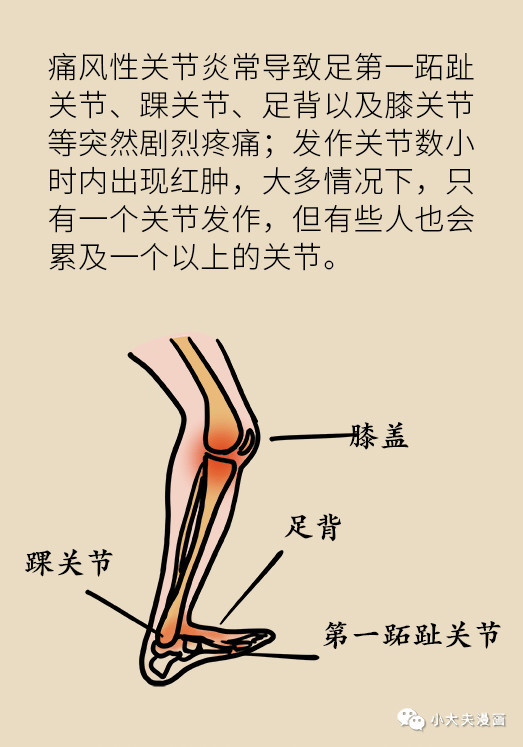 尿酸高的危险不只是痛风,这个并发症才最可怕!