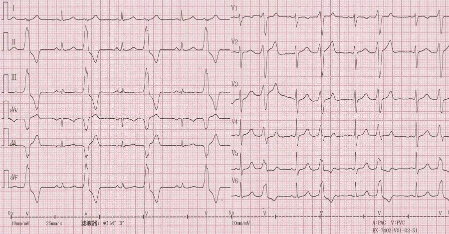 李女士的心电图提示为室早二联律