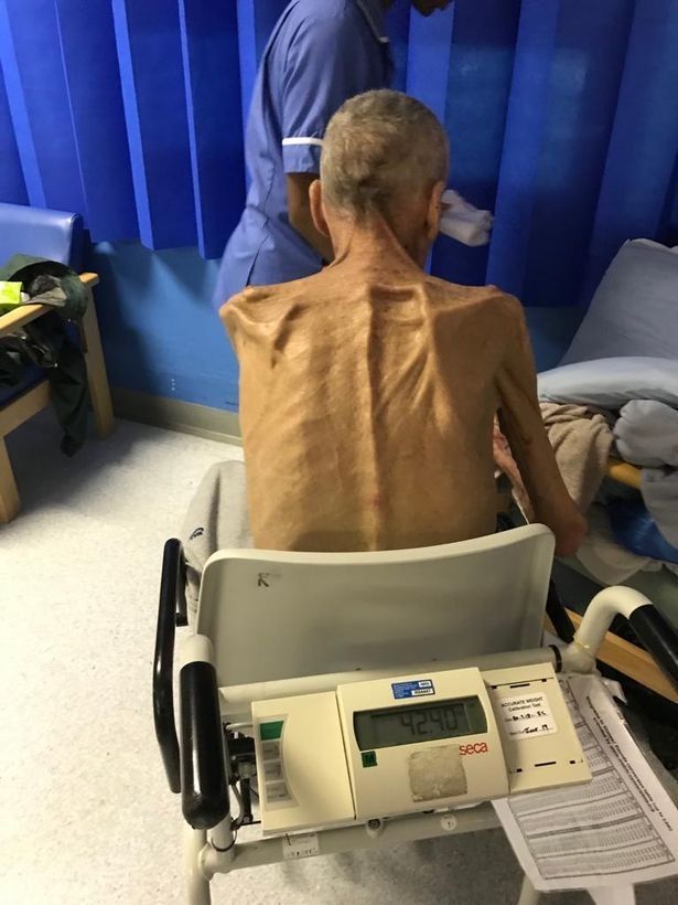 英国64岁老人瘦成骷髅却仍被要求工作,晒照状告政府获