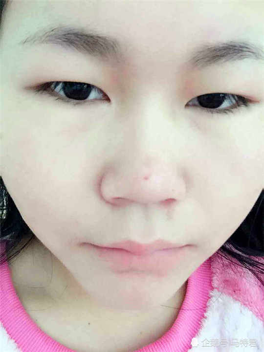 如果有双眼皮的人,可能还会因为是肿泡眼而变成了单眼皮,眼睛就像被