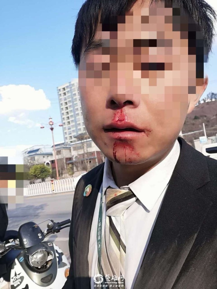楚雄街头一井盖成马路陷阱,两小伙骑车路过惨被摔掉5颗门牙