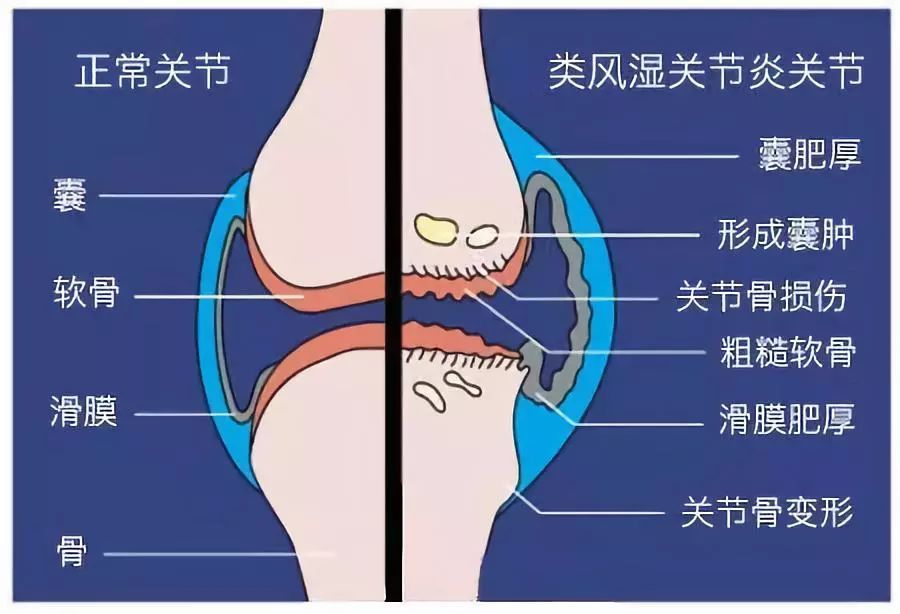 人体关节滑膜构造图