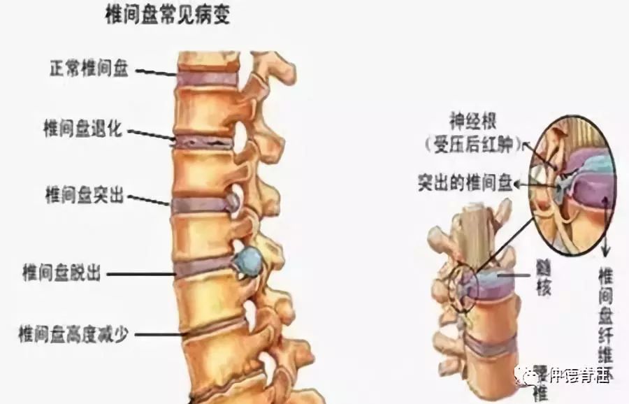 脊柱常见病科普之腰椎间盘突出症