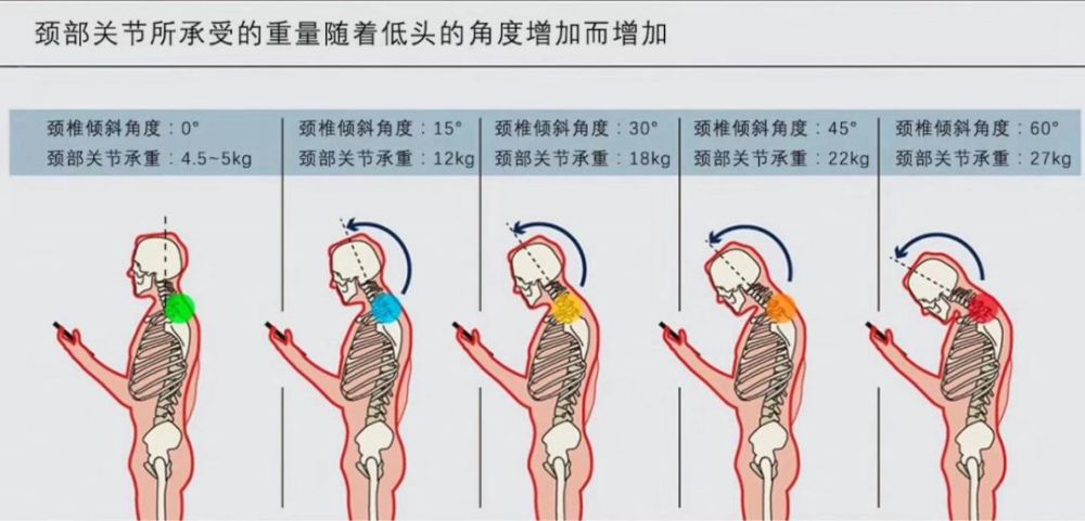 1,颈椎强直和颈椎反弓:导致很多严重疾病.
