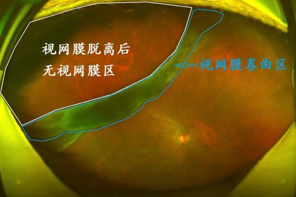 右眼视网膜周边部巨大裂孔,视网膜卷曲.
