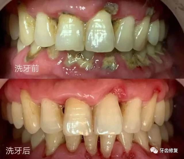 洗牙前后对比