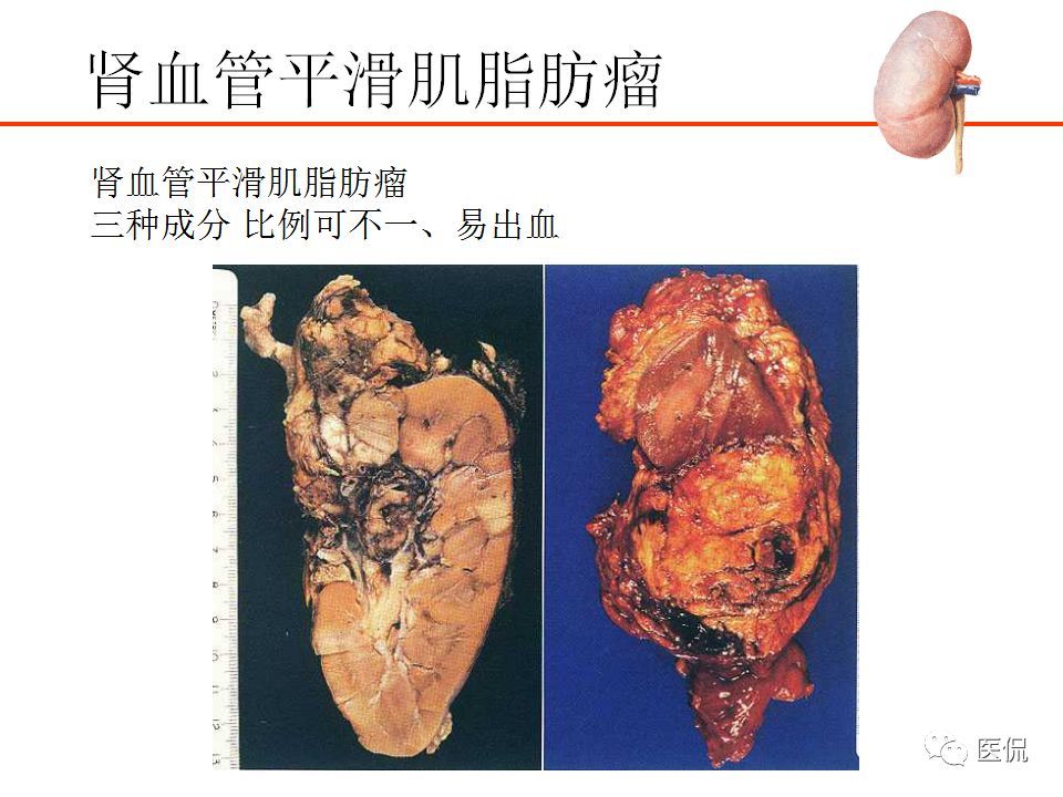 6个随访病例搞清:肾血管平滑肌脂肪瘤vs肾细胞癌的鉴别诊断