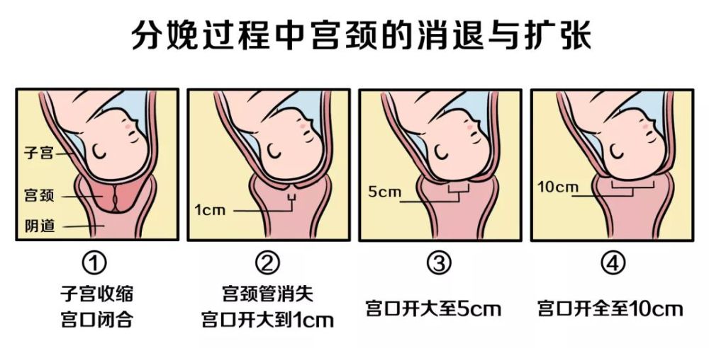开指俗称开宫口,专业术语为"子宫颈口扩张".