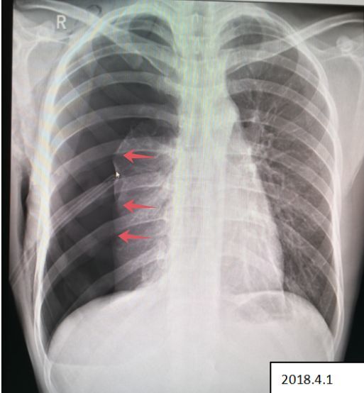 气胸的x线表现,6个病例帮你搞定!