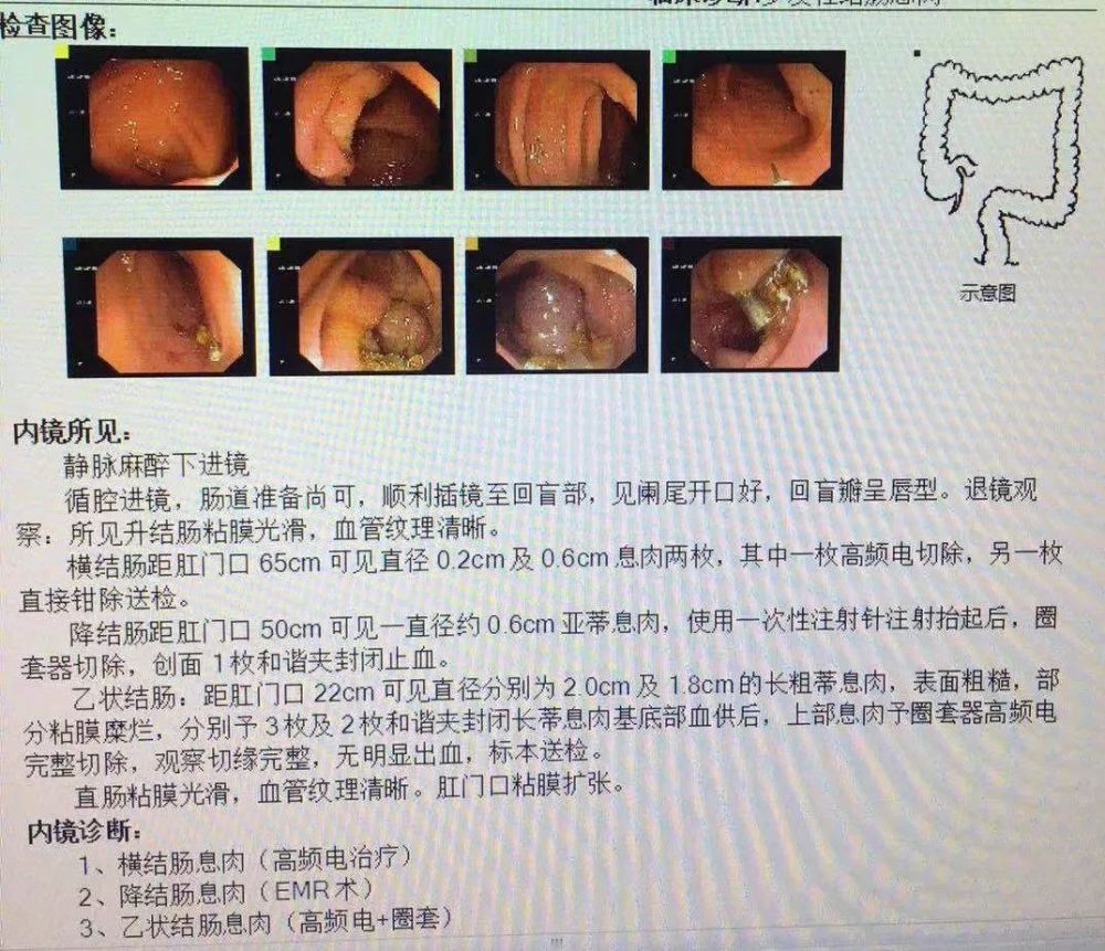新县人民医院内镜室成功完成一例高难度结肠息肉切除术