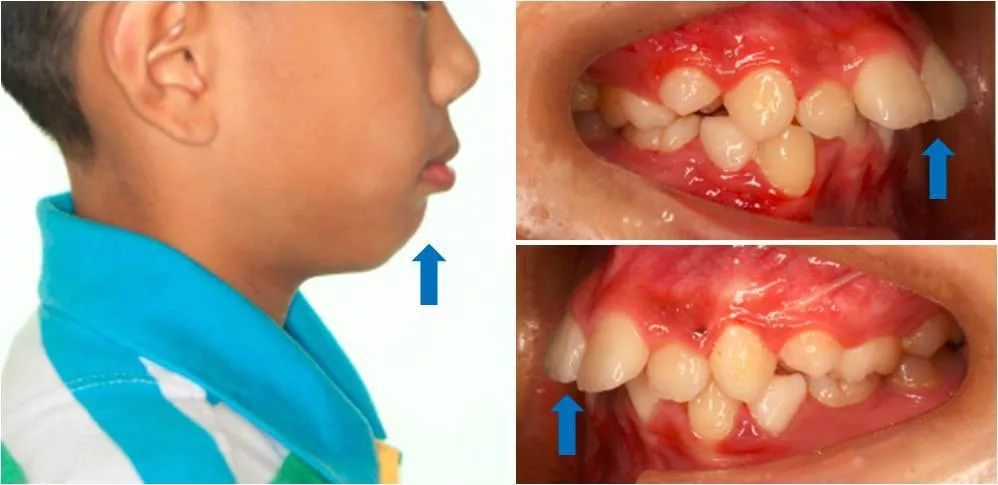 如果长期咬上唇,会形成下颌前伸畸形,俗称"地包天".