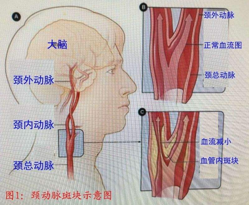 颈动脉狭窄有哪些病因?