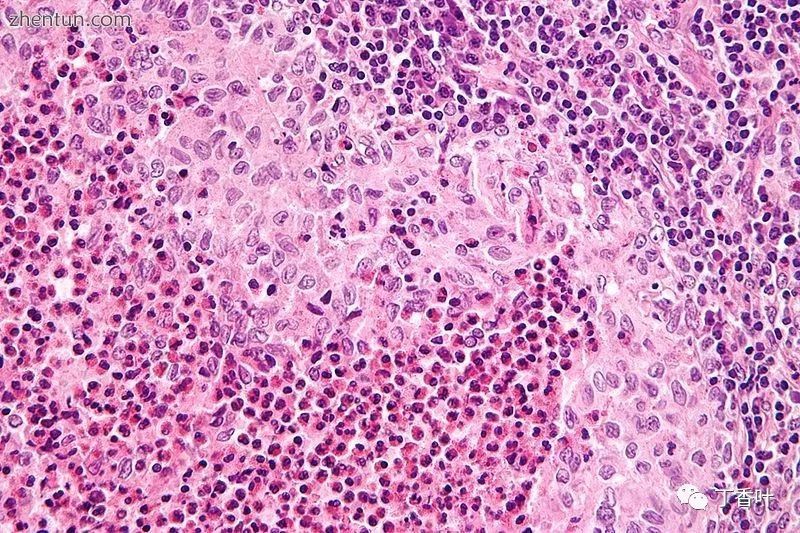 朗格汉斯组织细胞增生症 langerhans cell histiocytosis