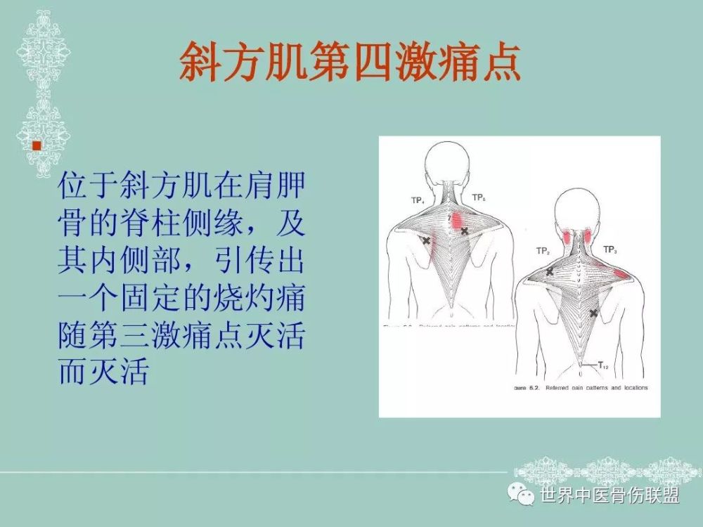 肌筋膜激痛点疗法-斜方肌