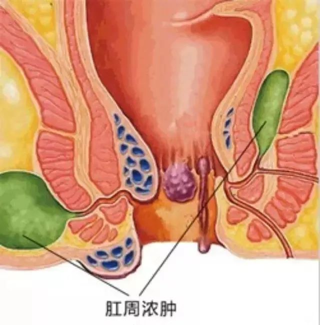 什么是肛周脓肿?——3月4日健康大讲堂直播与你有约!