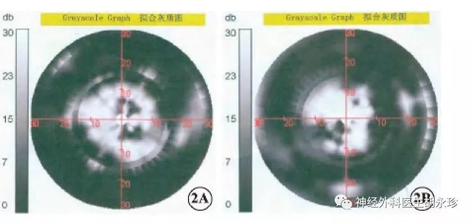 双眼视盘色淡, 右眼视盘颞侧可见点,片状黄白色渗出 视野缺损在空蝶鞍