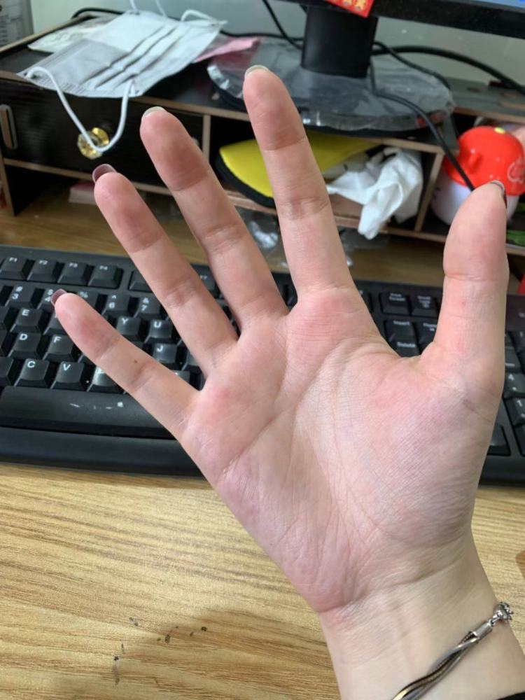 手上这些小颗粒可千万不能大意,这可能不是小问题,早知早好