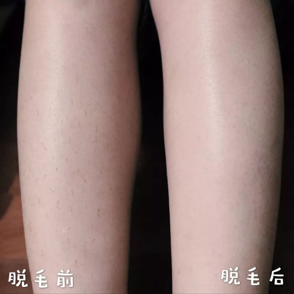 亲测6 种脱毛方法,最最最最有效的居然是这一种!