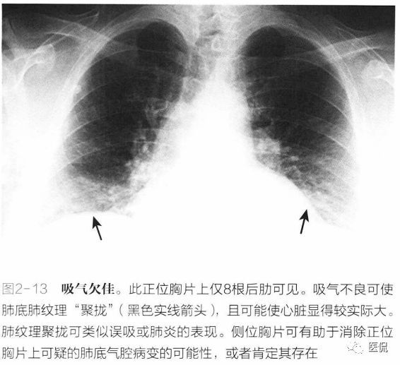 解决方案:观察x线侧位胸片以证实肺炎存在.