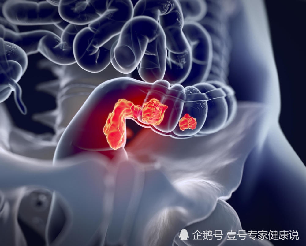便秘是肠癌前兆?大便出现这种"异象",你需要尽快做肠镜