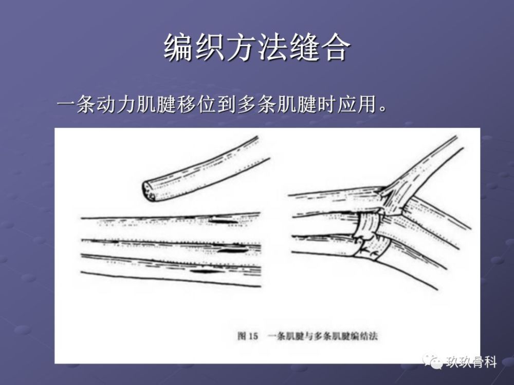 肌腱的缝合和固定技术