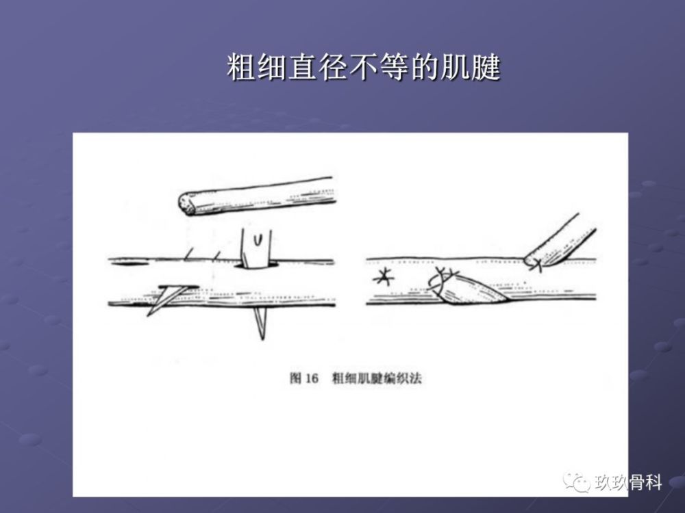 肌腱的缝合和固定技术