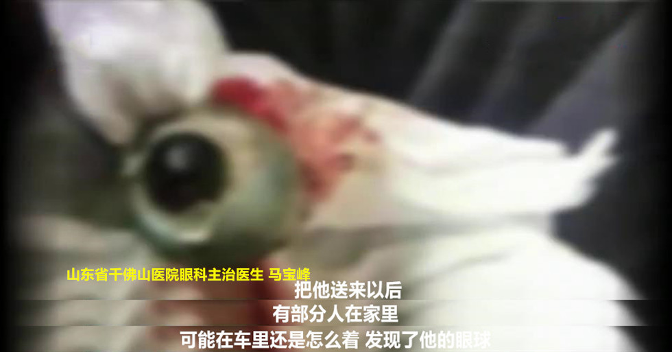眼球也会"脱臼"?小伙醉酒摔倒 起来左眼不见了