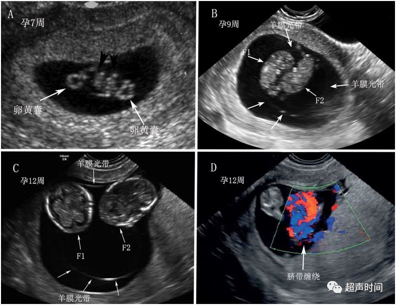 双胎妊娠:卵黄囊数不等于羊膜囊数