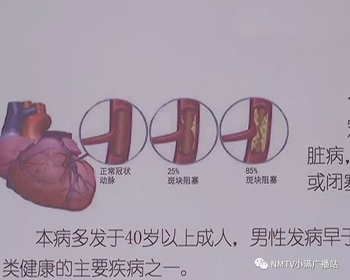 内蒙古首例经远桡动脉路径冠状动脉介入手术取得成功