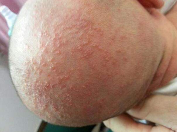 宝宝长湿疹会传染吗?