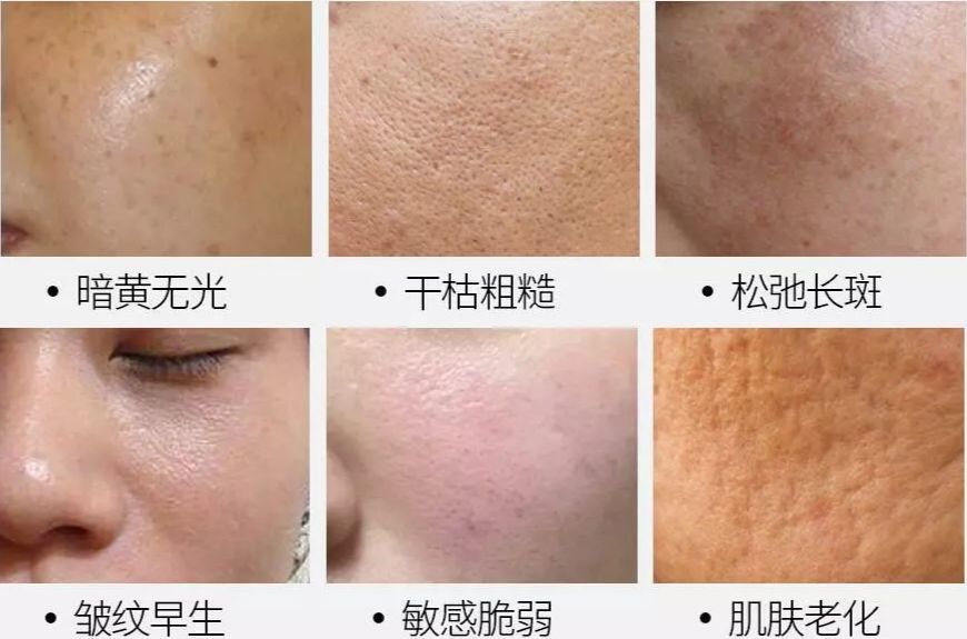 结果就是: 皮肤会逐渐垮塌,导致斑点,皱纹,黑色素的堆积.