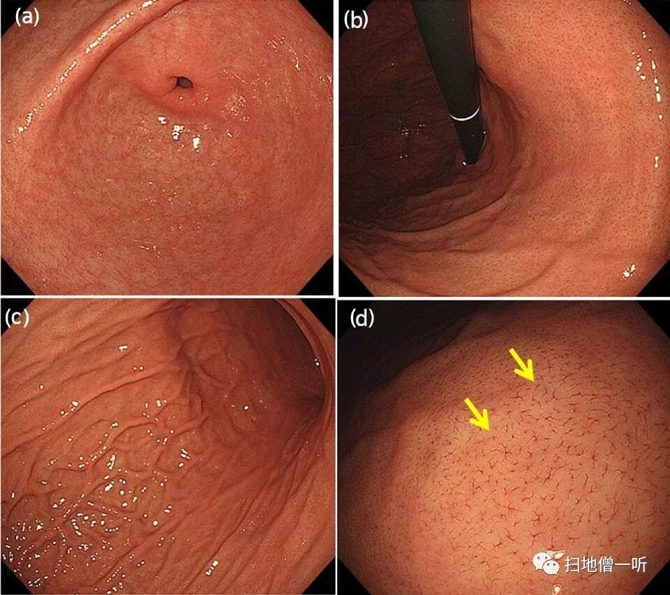 幽门螺杆菌阴性胃癌内镜下特征