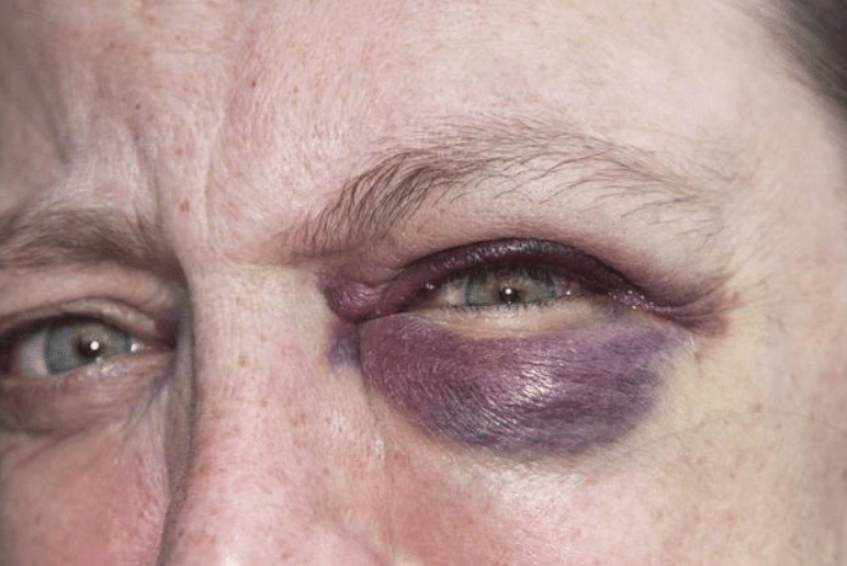 长时间的眼睛肿胀,眼睑下垂,需要警惕肺癌来临.