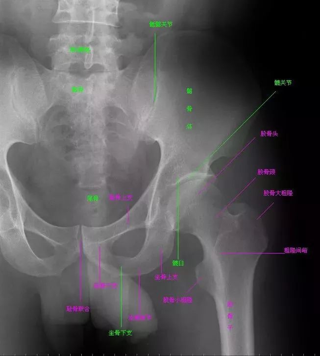 骨盆x线解剖详解