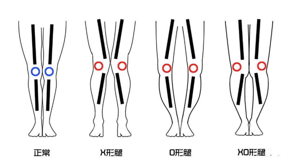 女生"o型腿"不算丑,这3种腿型才是一言难尽,难怪异性缘差