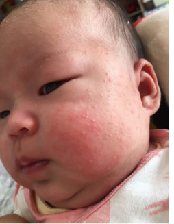 宝宝湿疹怎么护理?湿疹怎么除根-天天快报