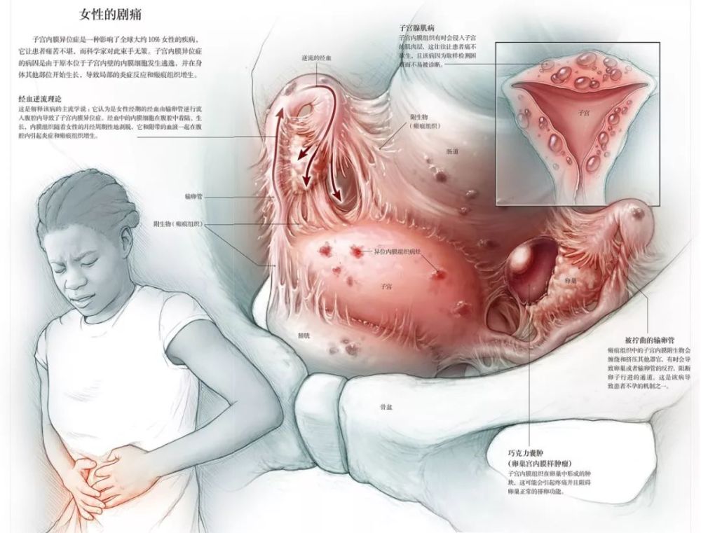 这种剧烈疼痛可致不孕,却被无数人当作