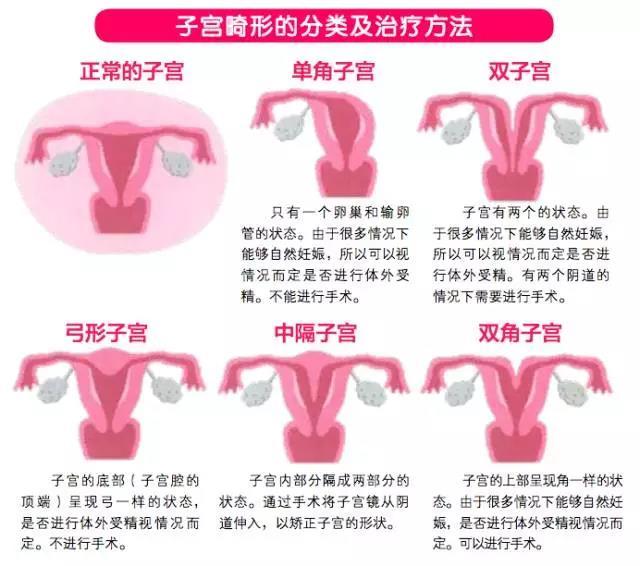 简单门诊手术即可去除 4 子宫畸形(子宫形态异常) 通常情况下,子宫