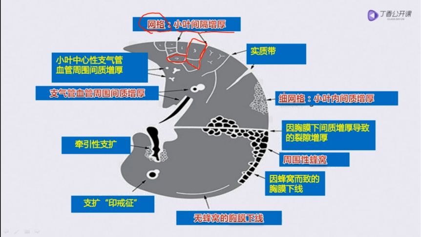 分分钟掌握:4 种肺间质病变的影像学改变