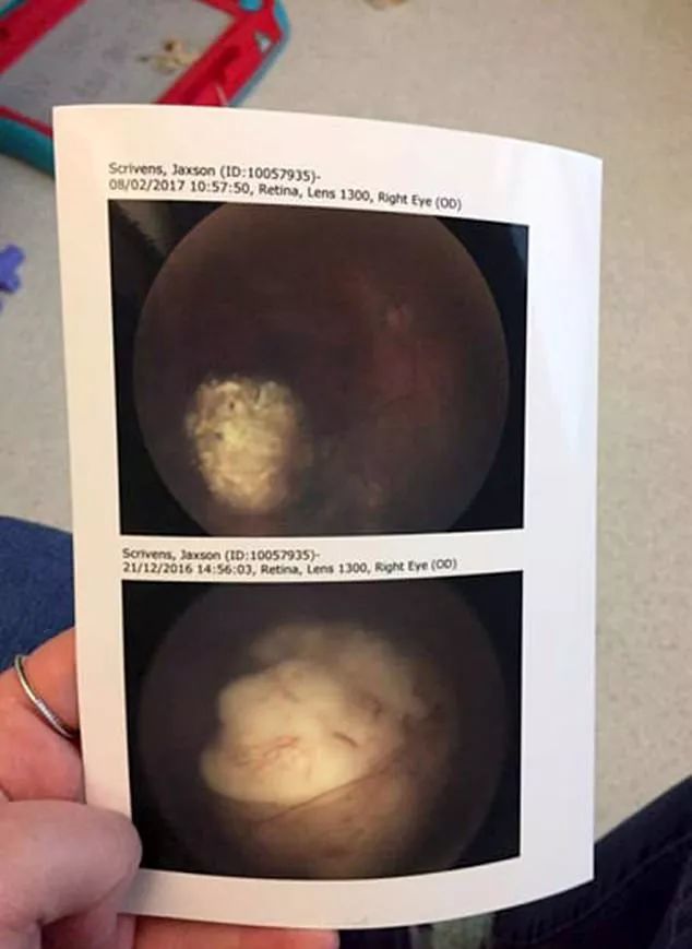 英国女子靠这张照片发现孩子患上眼癌