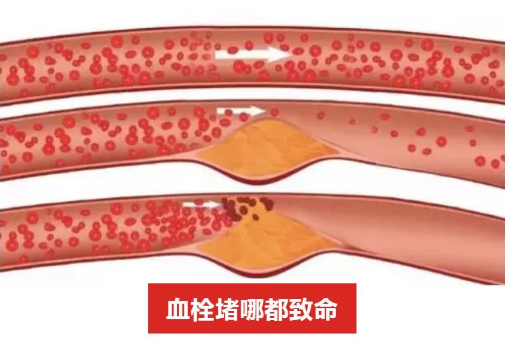血管"生锈",高血糖?这瓶植物燕窝,4周让你减脂排毒远离三高!