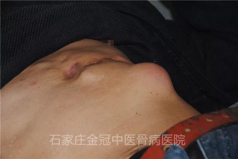 骨结核手术后的注意事项有哪些?