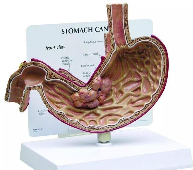 胃癌,是生活中常见的一种恶性肿瘤,我国胃癌发病率很高,全球40%的胃癌