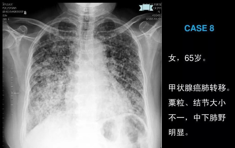 女人为什么都不愿做"胸透"?医生会清晰的看到什么?