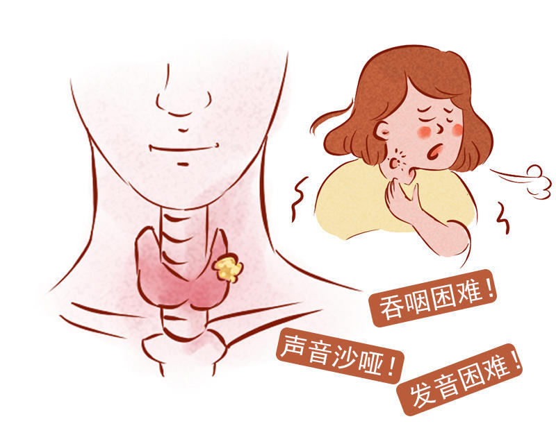 留意甲状腺癌7大症状,早发现早治疗