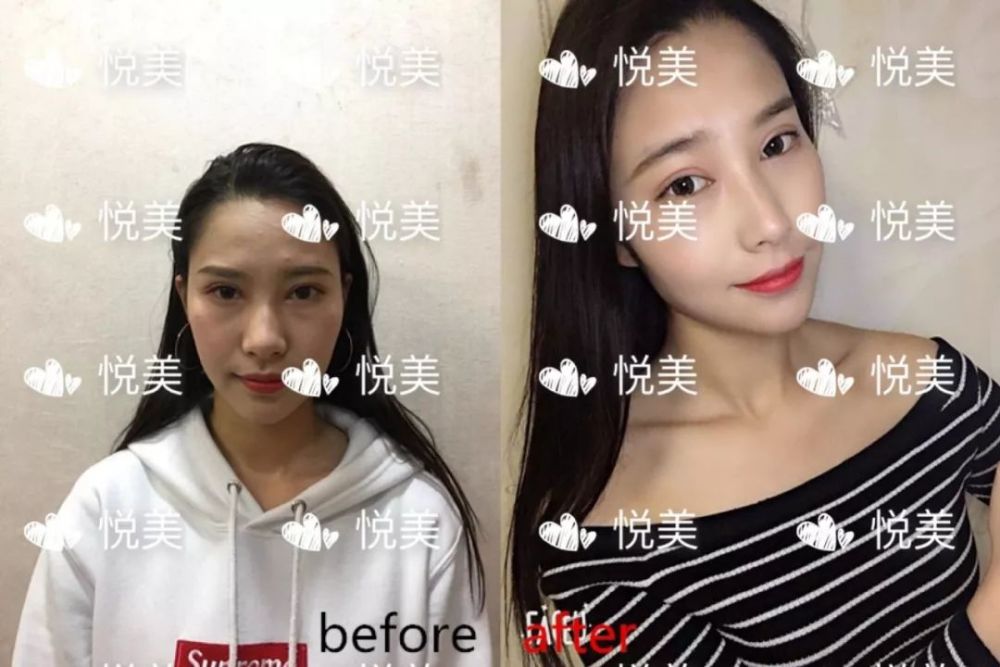 高清图解!独家揭秘肋软骨隆鼻全过程!你要的全在这儿!