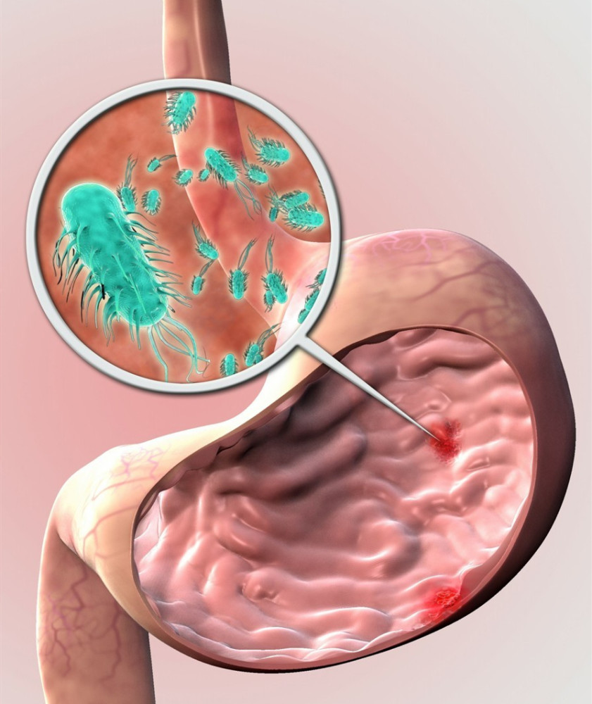 感染幽门螺杆菌会致口臭?医生:多做1事,多吃2